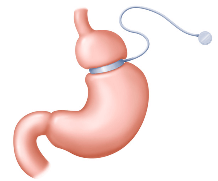 Gastric banding for weight loss in guadalajara