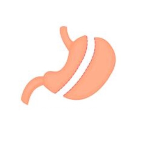 gastric sleeve surgery in guadalajara