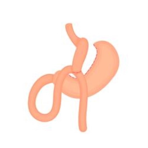 gastric Mini bypass surgery in guadalajara